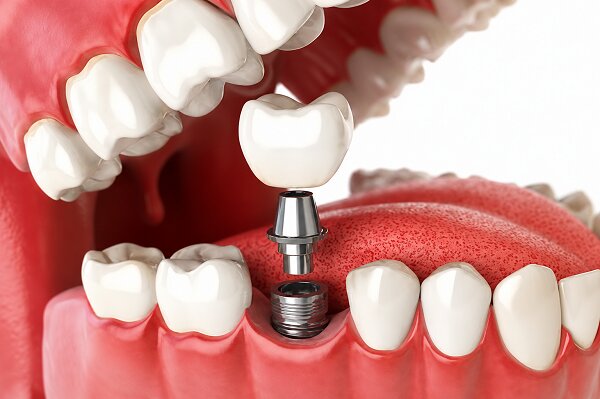 Best Dental Implant Clinic in Sanpada
