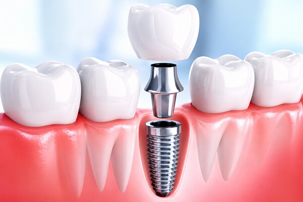 Best Dental Implant Clinic in Seawoods