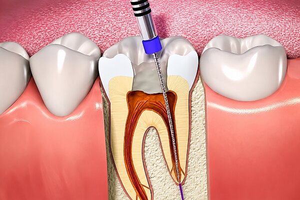 Best Root Canal Treatment in Nerul