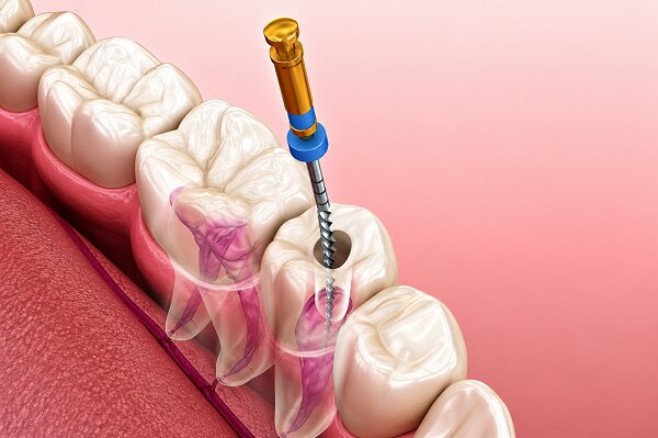 Best Root Canal Treatment in Seawoods